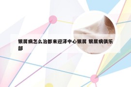 银屑病怎么治都来迎泽中心银屑 银屑病俱乐部