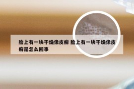 脸上有一块干燥像皮癣 脸上有一块干燥像皮癣是怎么回事