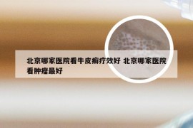 北京哪家医院看牛皮癣疗效好 北京哪家医院看肿瘤最好