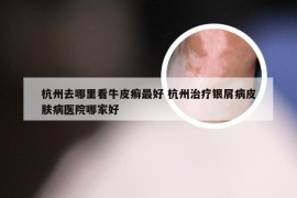 杭州去哪里看牛皮癣最好 杭州治疗银屑病皮肤病医院哪家好