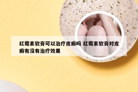 红霉素软膏可以治疗皮癣吗 红霉素软膏对皮癣有没有治疗效果