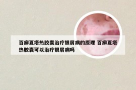 百癣夏塔热胶囊治疗银屑病的原理 百癣夏塔热胶囊可以治疗银屑病吗