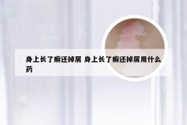 身上长了癣还掉屑 身上长了癣还掉屑用什么药