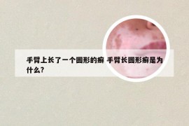 手臂上长了一个圆形的癣 手臂长圆形癣是为什么?
