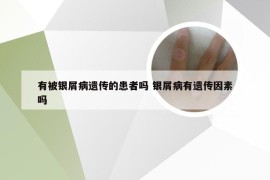 有被银屑病遗传的患者吗 银屑病有遗传因素吗