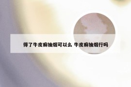 得了牛皮癣抽烟可以么 牛皮癣抽烟行吗