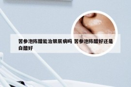 苦参泡陈醋能治银屑病吗 苦参泡陈醋好还是白醋好
