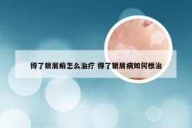 得了银屑癣怎么治疗 得了银屑病如何根治