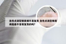 急性点滴型银屑病不易复发 急性点滴型银屑病是最不容易复发的吗?