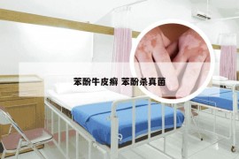 苯酚牛皮癣 苯酚杀真菌