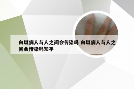 白斑病人与人之间会传染吗 白斑病人与人之间会传染吗知乎