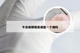 牛皮癣跟银屑病是一个病吗