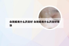 白斑癣用什么药膏好 白斑癣用什么药膏好得快