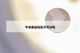 牛皮癣运动出汗可以吗