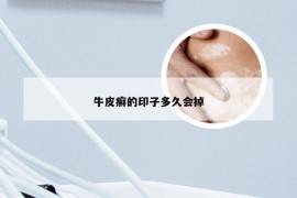 牛皮癣的印子多久会掉