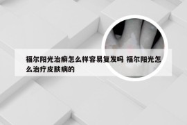 福尔阳光治癣怎么样容易复发吗 福尔阳光怎么治疗皮肤病的