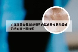 内江哪里去看皮肤科好 内江市看皮肤科最好的地方哪个医院呢