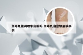 血毒丸能调理牛皮癣吗 血毒丸治愈银屑病事例