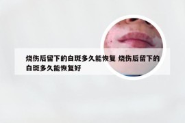 烧伤后留下的白斑多久能恢复 烧伤后留下的白斑多久能恢复好