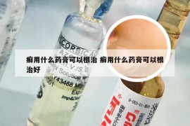 癣用什么药膏可以根治 癣用什么药膏可以根治好