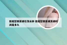 脓疱型银屑病引发水肿 脓疱型银屑病发病时间是多久