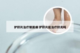 护肝片治疗银屑病 护肝片能治疗肝炎吗