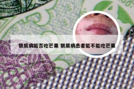 银屑病能否吃芒果 银屑病患者能不能吃芒果
