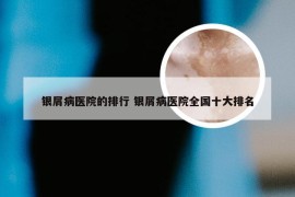 银屑病医院的排行 银屑病医院全国十大排名