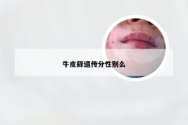 牛皮藓遗传分性别么