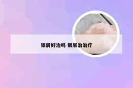 银屑好治吗 银屑治治疗