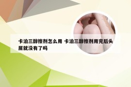 卡泊三醇擦剂怎么用 卡泊三醇擦剂用完后头屑就没有了吗
