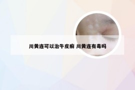 川黄连可以治牛皮癣 川黄连有毒吗