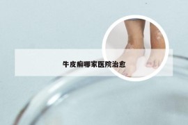 牛皮癣哪家医院治愈