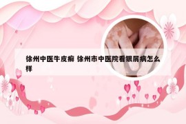 徐州中医牛皮癣 徐州市中医院看银屑病怎么样