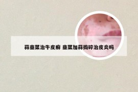 蒜韭菜治牛皮癣 韭菜加蒜捣碎治皮炎吗