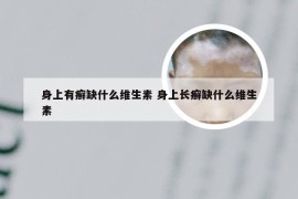 身上有癣缺什么维生素 身上长癣缺什么维生素