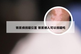 银屑病拔罐位置 银屑病人可以拔罐吗
