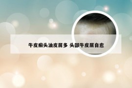 牛皮癣头油皮屑多 头部牛皮屑自愈