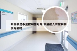 银屑病是不是控制都好难 银屑病人有控制的很好的吗