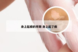 身上起癣的早期 身上起了癣