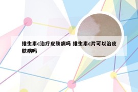 维生素c治疗皮肤病吗 维生素c片可以治皮肤病吗