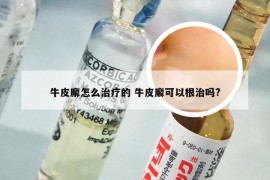 牛皮廨怎么治疗的 牛皮廨可以根治吗?