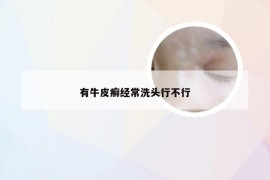 有牛皮癣经常洗头行不行