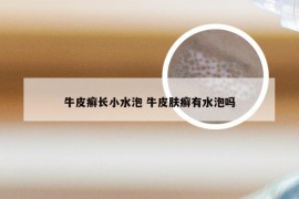 牛皮癣长小水泡 牛皮肤癣有水泡吗