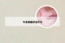 牛皮癣最好治疗方