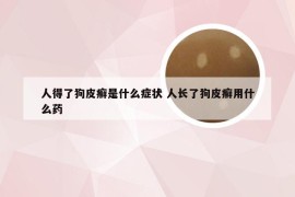 人得了狗皮癣是什么症状 人长了狗皮癣用什么药