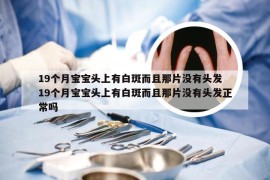 19个月宝宝头上有白斑而且那片没有头发 19个月宝宝头上有白斑而且那片没有头发正常吗