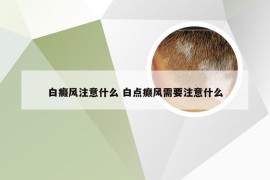 白癜风注意什么 白点癫风需要注意什么