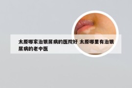 太原哪家治银屑病的医院好 太原哪里有治银屑病的老中医