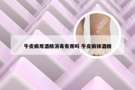 牛皮癣用酒精消毒有用吗 牛皮癣抹酒精